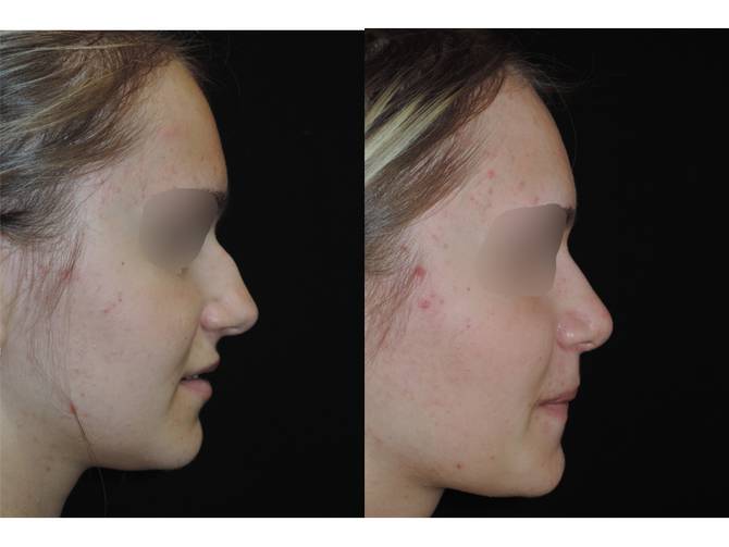 Rinoplastica | Immagini pre/post 15
