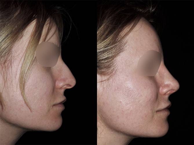 Rinoplastica | Immagini pre/post 14