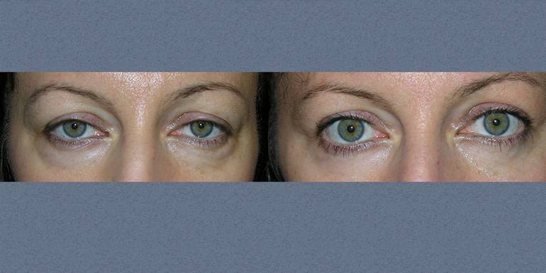 Blefaroplastica | Immagini pre/post 8