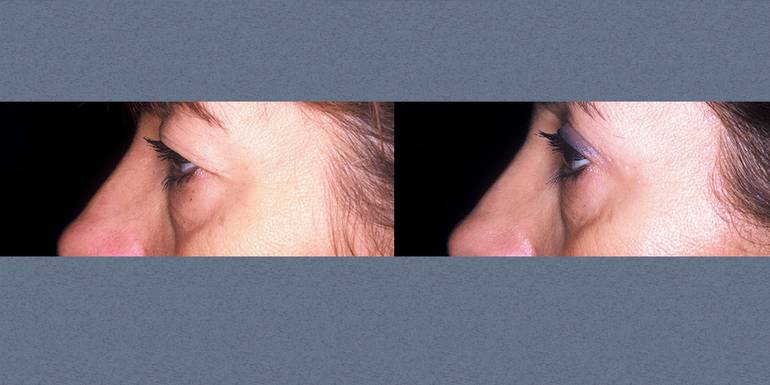 Blefaroplastica | Immagini pre/post 7