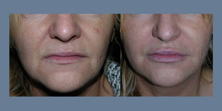 Labbra | Immagini pre/post 1