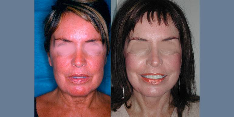 Lifting | Immagini pre/post 3