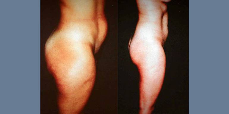 Liposcultura | Immagini pre/post 3