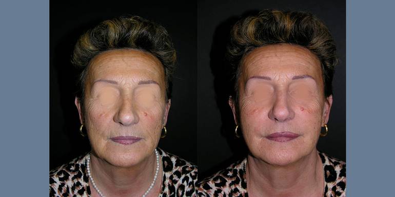 Lipostruttura | Immagini pre/post 1