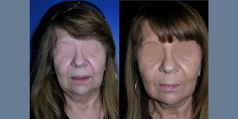 Lipostruttura | Immagini pre/post 2