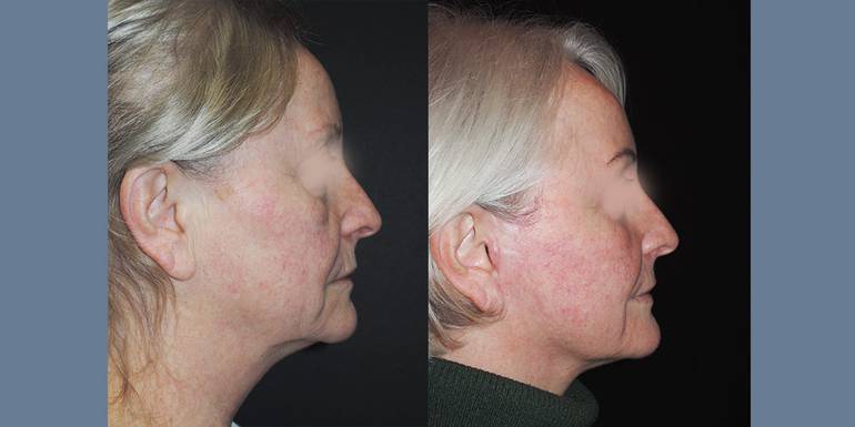 Minilifting | Immagini pre/post 3