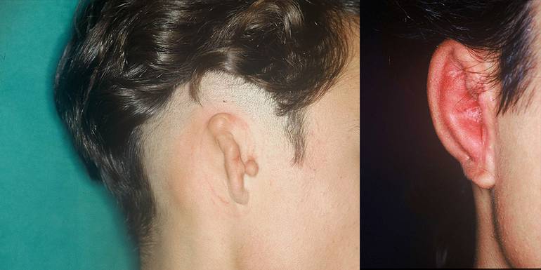 Ricostruzione Orecchio | Immagini pre/post 3