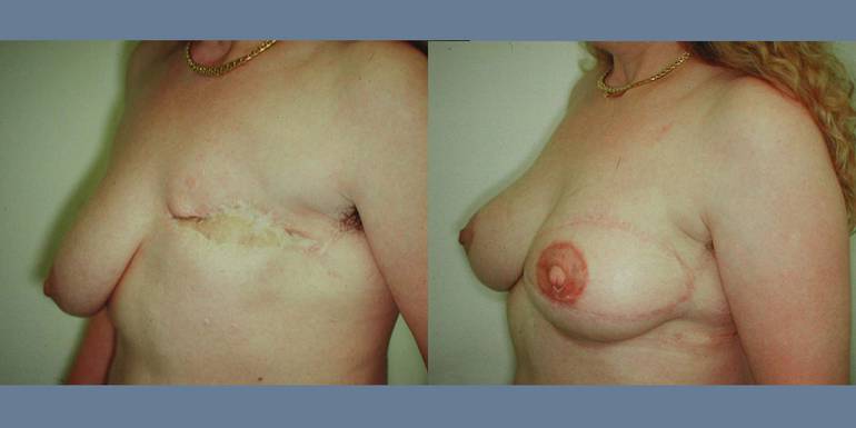 Ricostruzione Mammaria | Immagini pre/post 2