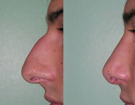 Rinoplastica | Immagini pre/post 1