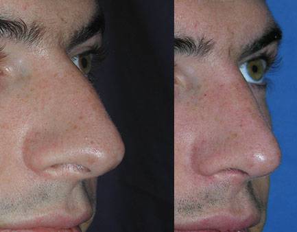 Rinoplastica | Immagini pre/post 3